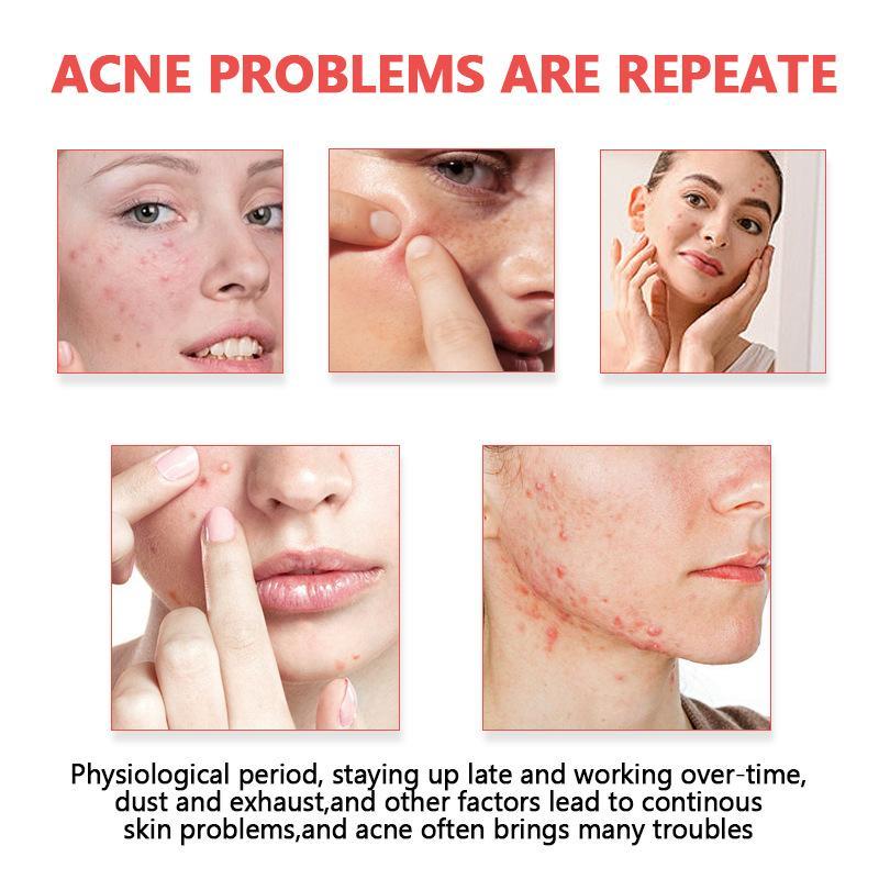 Acne Patches Invisible Hydroco - огляд і ціна Skincare Oil Control